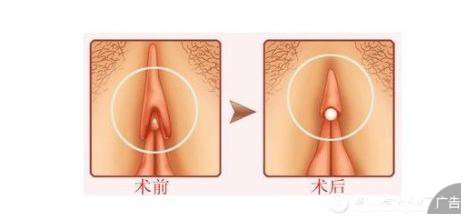 阴蒂整形术的费用要多少？