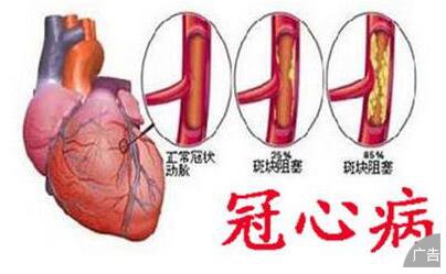 冠心病的治疗方法具体有哪些