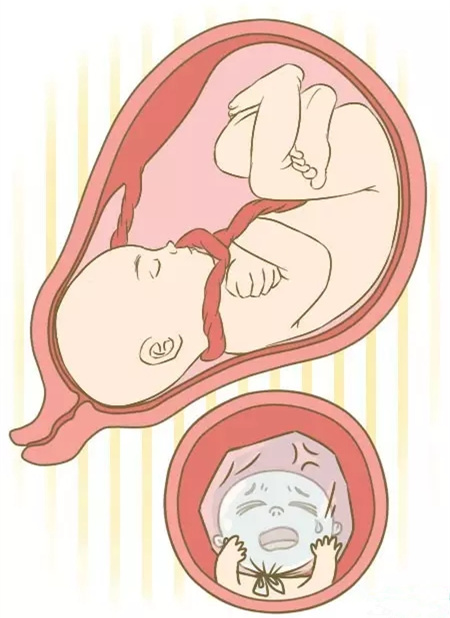 什么是胎儿窘迫